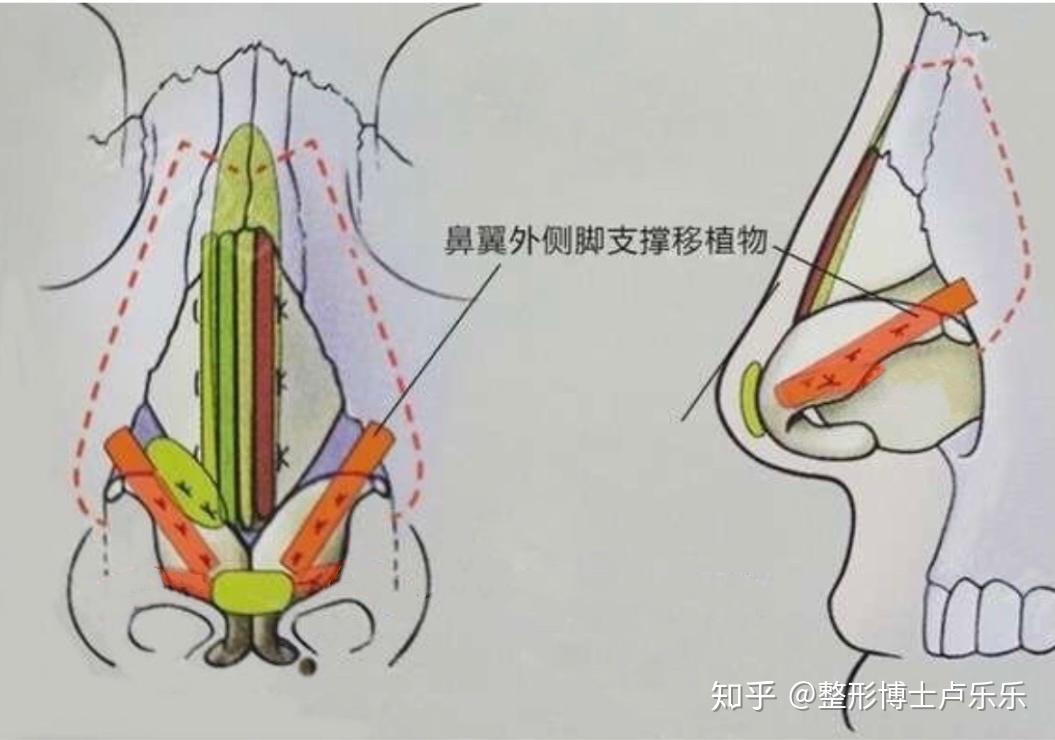 鼻翼软骨分离图片