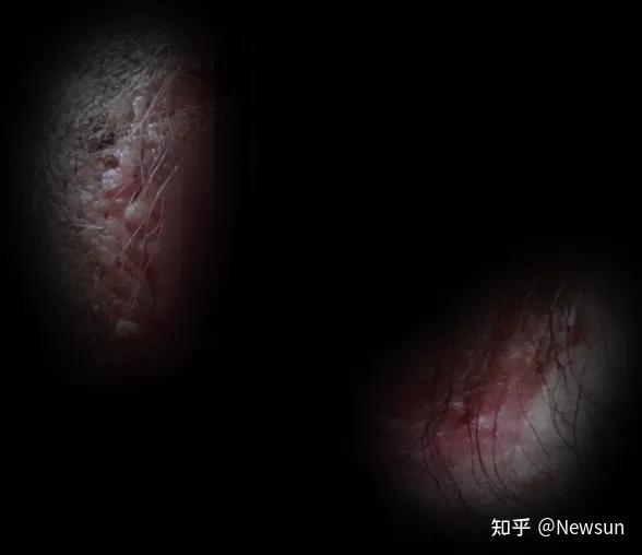 尖锐湿疣与假性湿疣区别(内附图片)