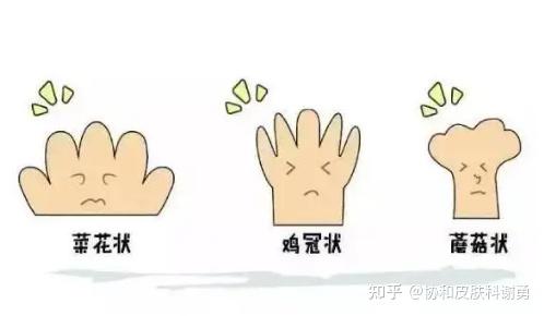 尖锐湿疣会得癌症? - 知乎