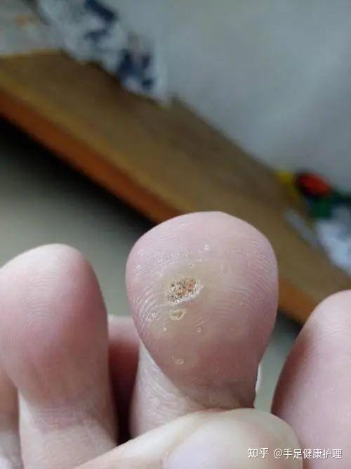 脚垫?胼胝?鸡眼?跖疣?刺猴?傻傻分不清? - 知乎