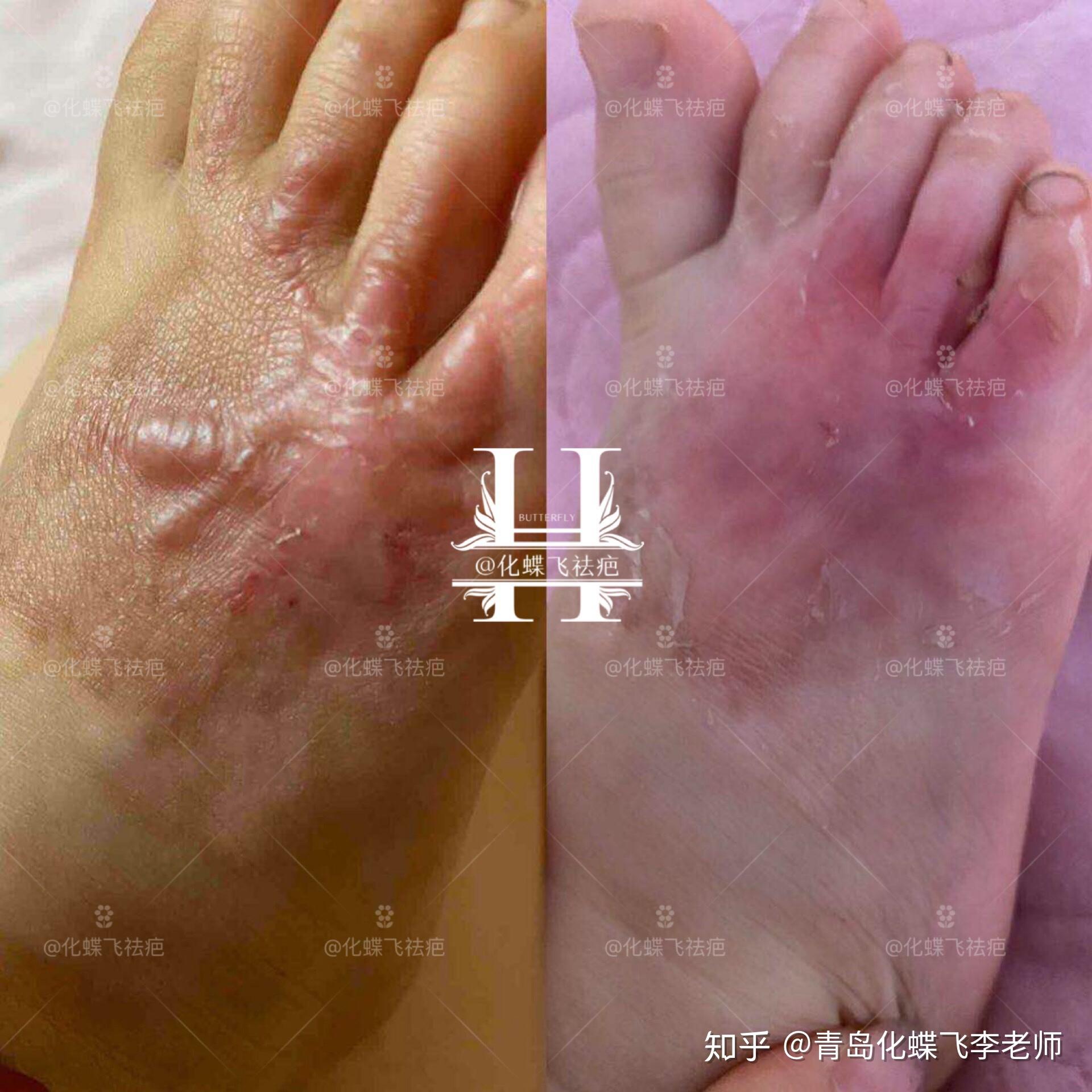 宝宝脚丫烫伤增生疤痕平复多了