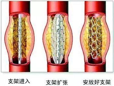 常见的心脏病治疗费用是多少呢 知乎