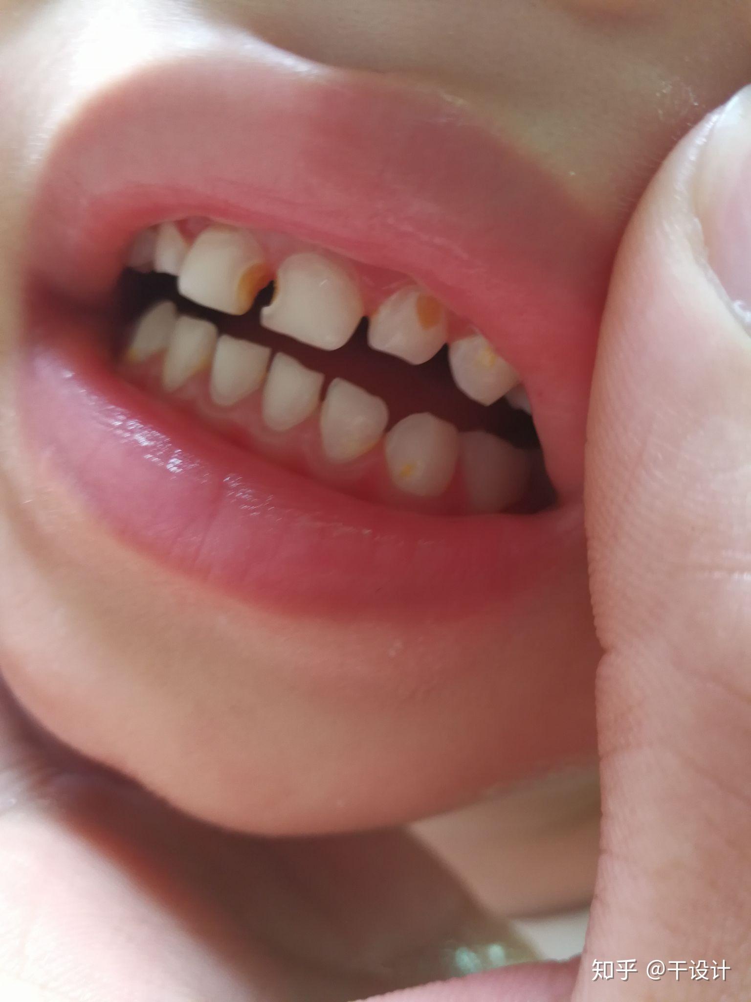 一周宝宝牙齿缺钙图片图片