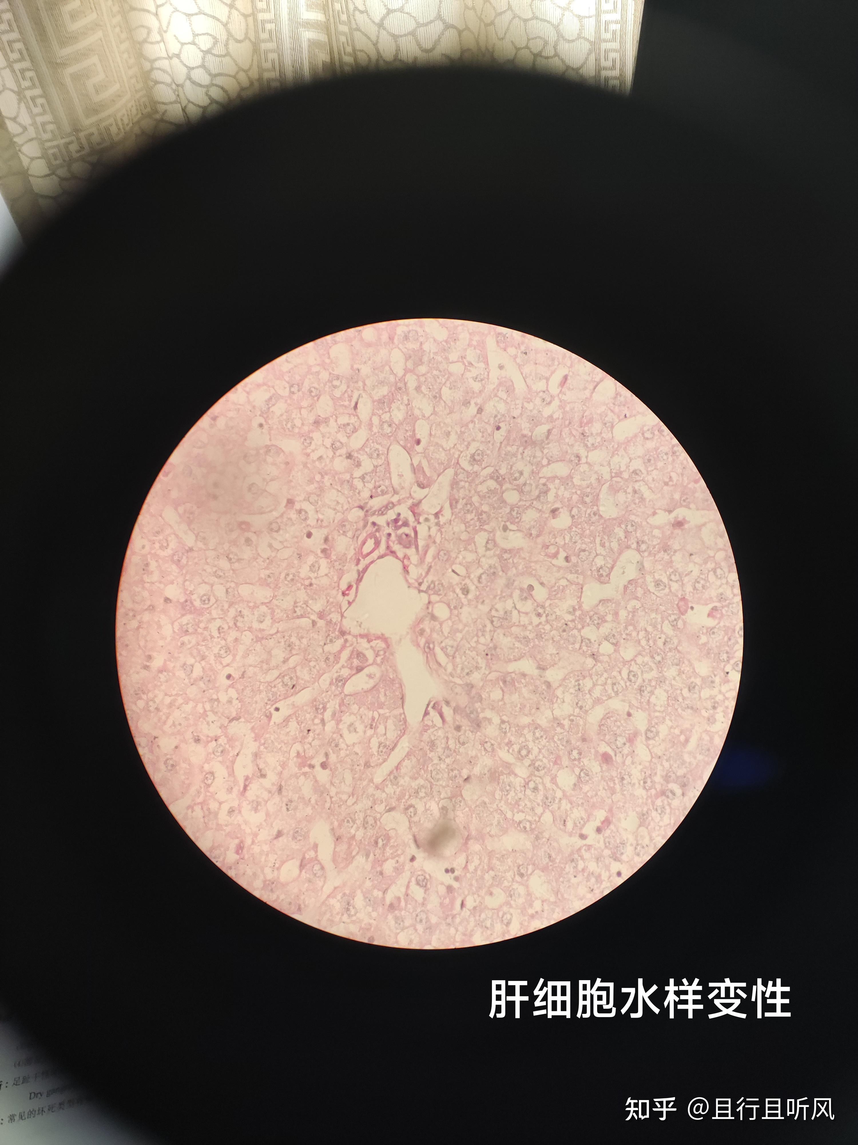 肝细胞颗粒变性图片