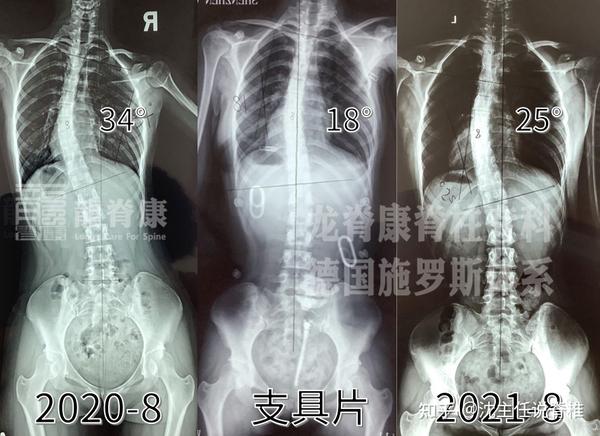孩子脊柱侧弯后,经过治疗能百分百变直,恢复正常吗? - 知乎