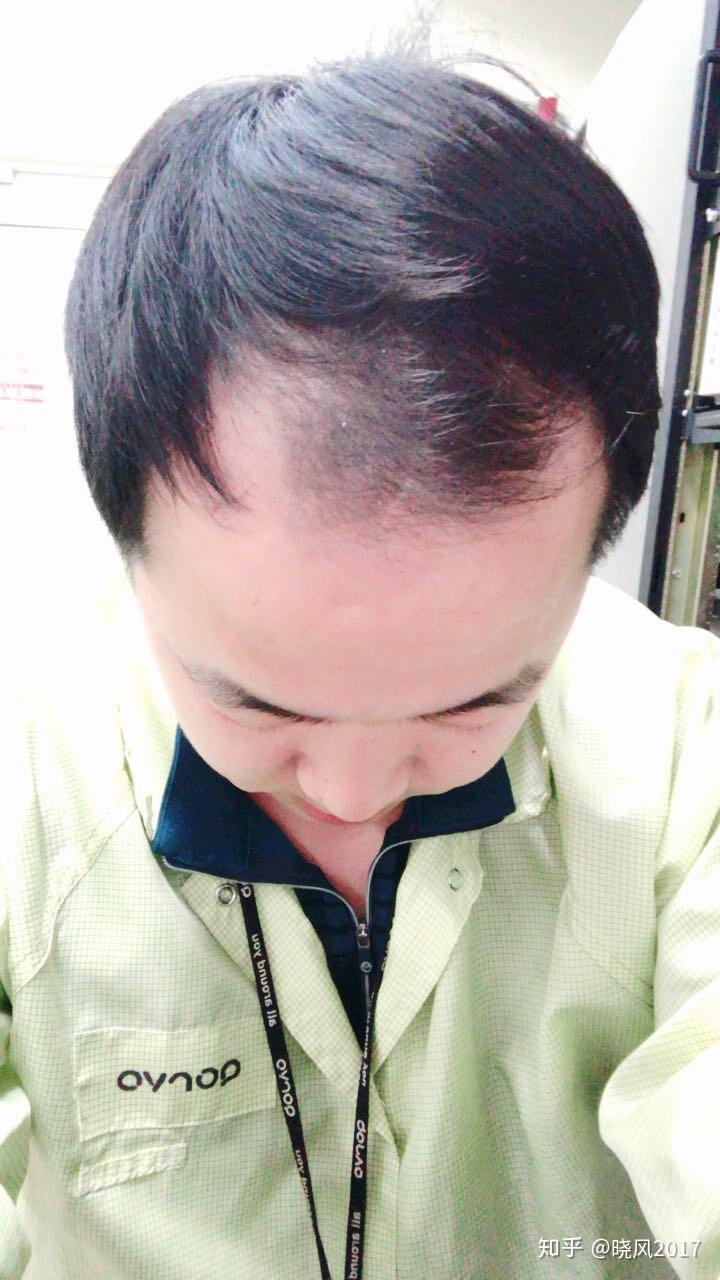 整容植发小哥图片(男士植发后的效果图片)