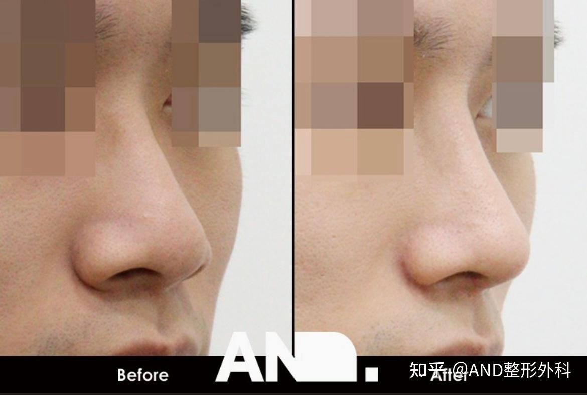 蒜头鼻怎样化妆能让鼻子看起来更挺、鼻羿小些
