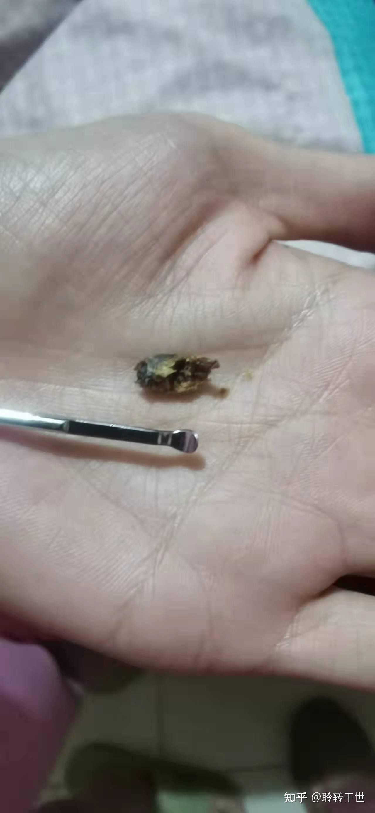 耳屎能大到什么程度? - 知乎