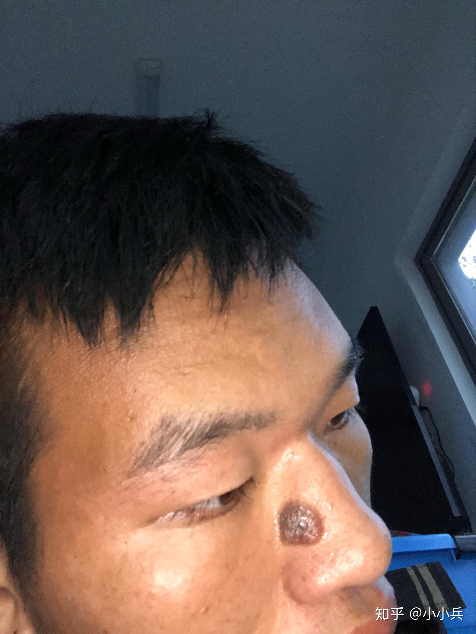 鼻子上有一个特大的黑色素痣能做掉吗