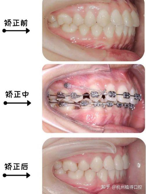 什么情况下需要打骨钉打骨钉痛吗