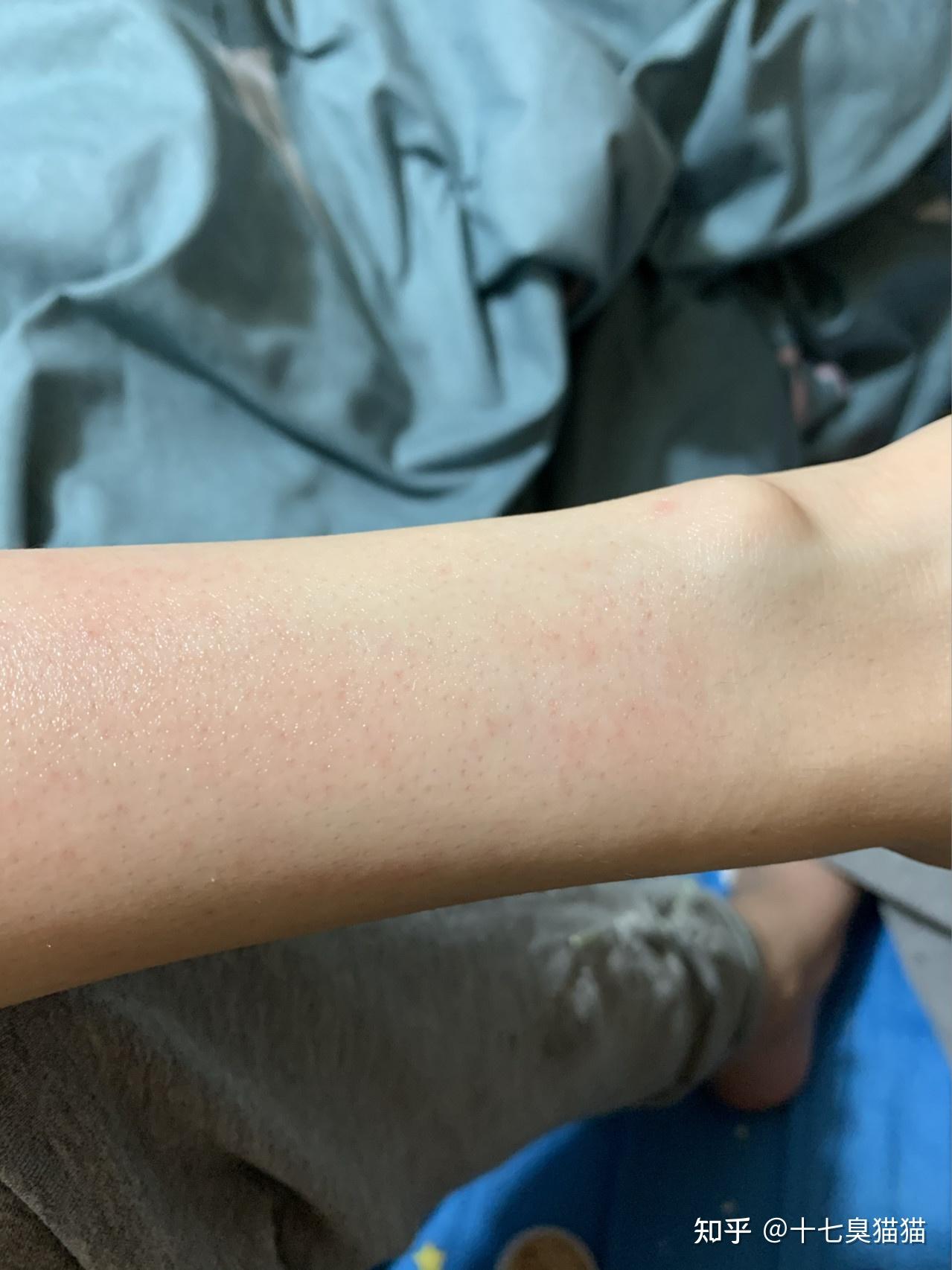 之前用过某牌子的脱毛膏,一涂上就直接过敏了!谁懂啊家人们?