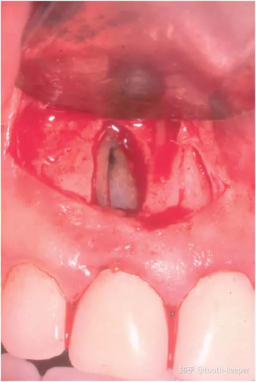 乾貨分享牙根縱裂的診斷