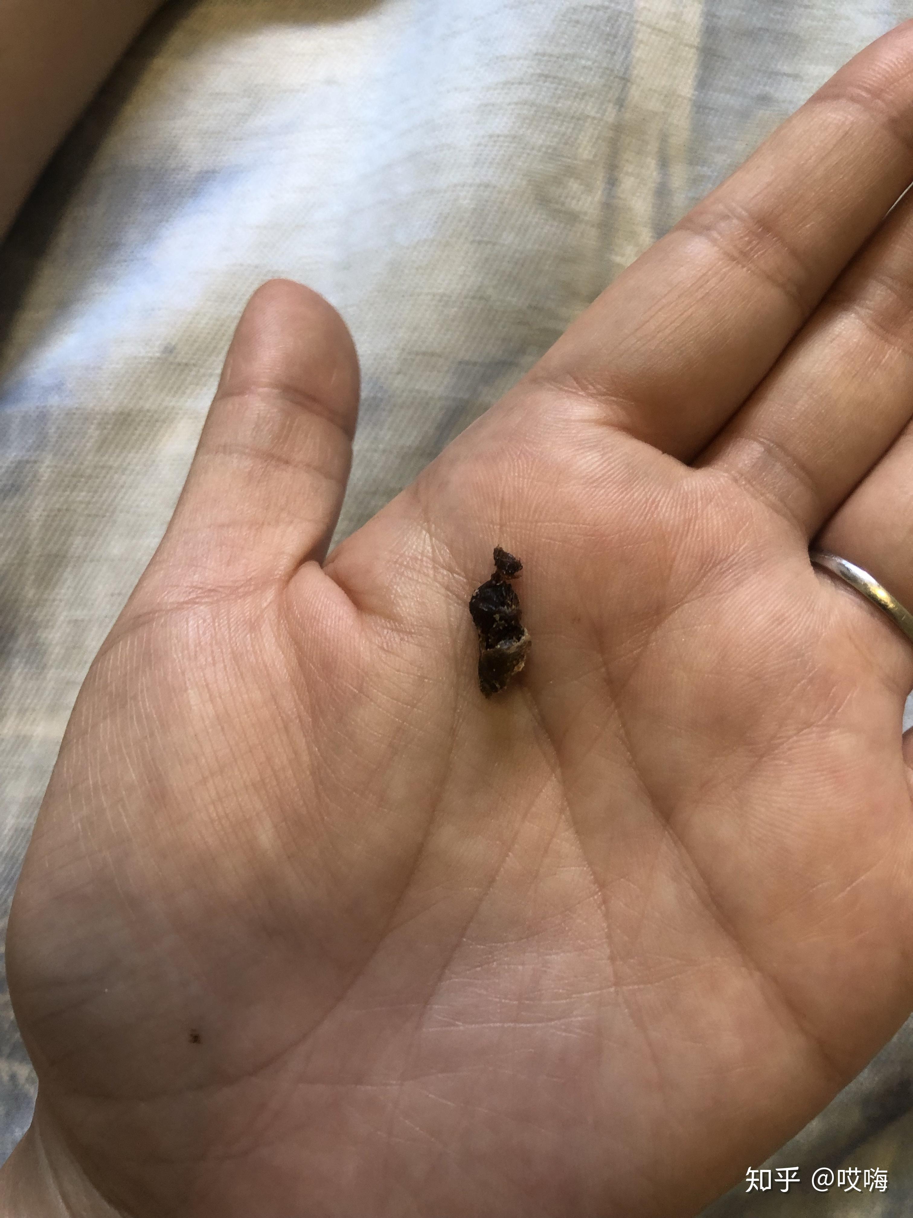 耳屎能大到什么程度?