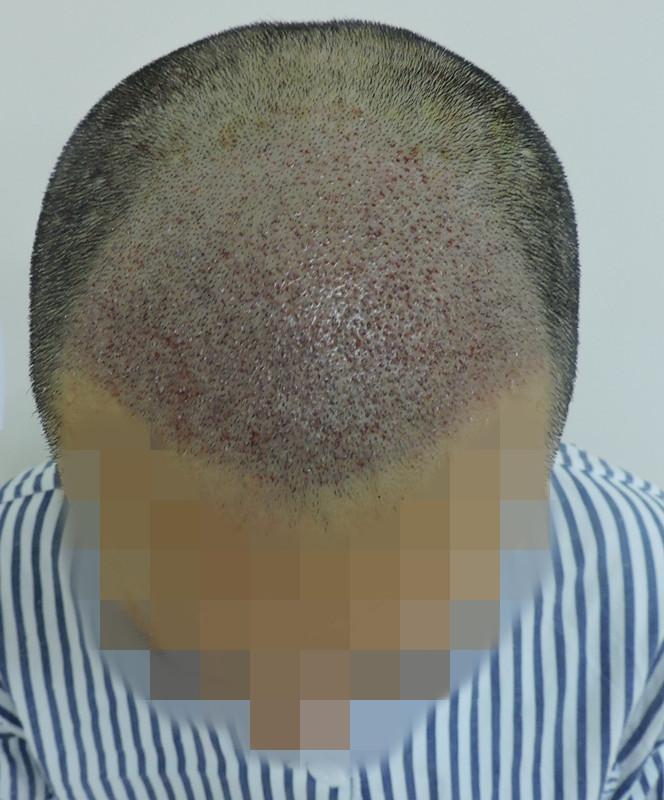 为什么秃顶的人这么多很少有做植发的?