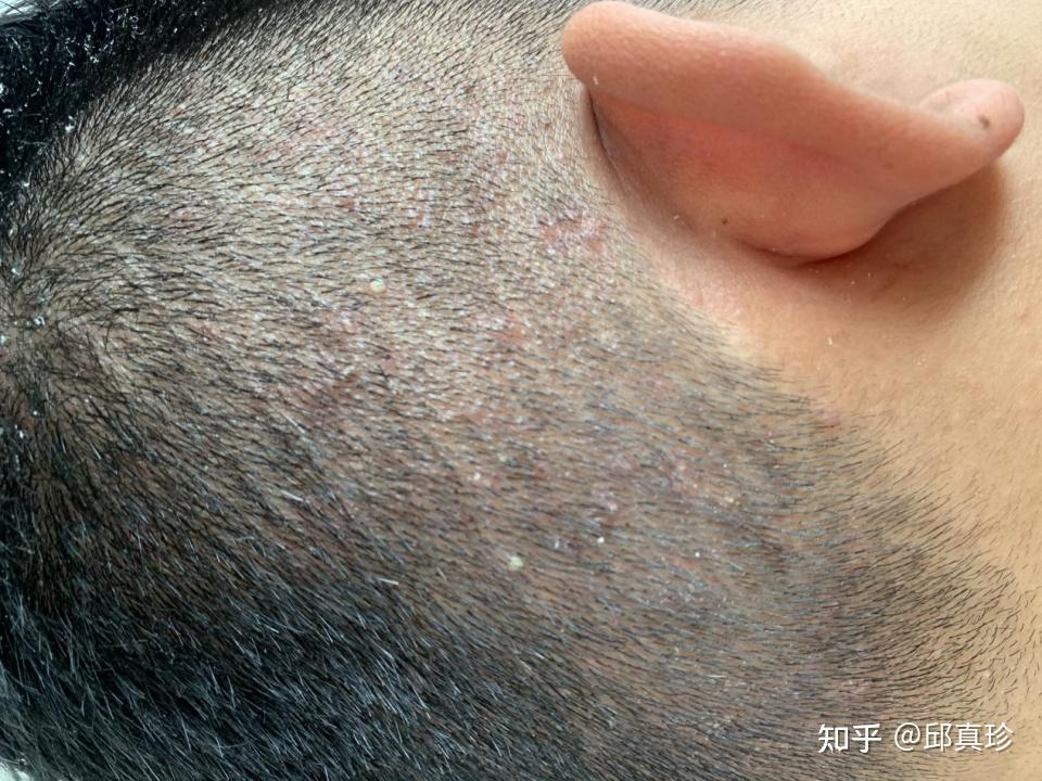 头皮上的马拉色菌毛囊炎,该怎么治疗? - 知乎