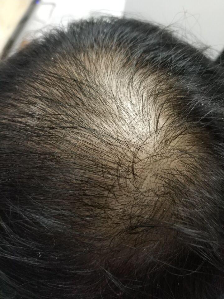 专家指出:脱发是指脱发的脱落,通常患者从头顶或者额头开始脱发,随着