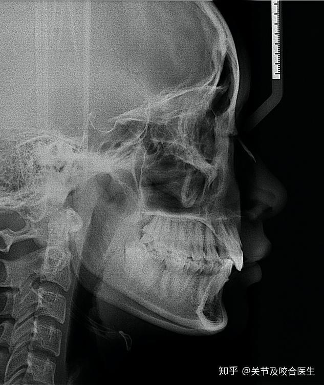 不可忽视的口腔正畸前常规tmj影像筛查