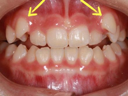 廈門牙齒矯正虎牙不好看為什麼不能拔掉