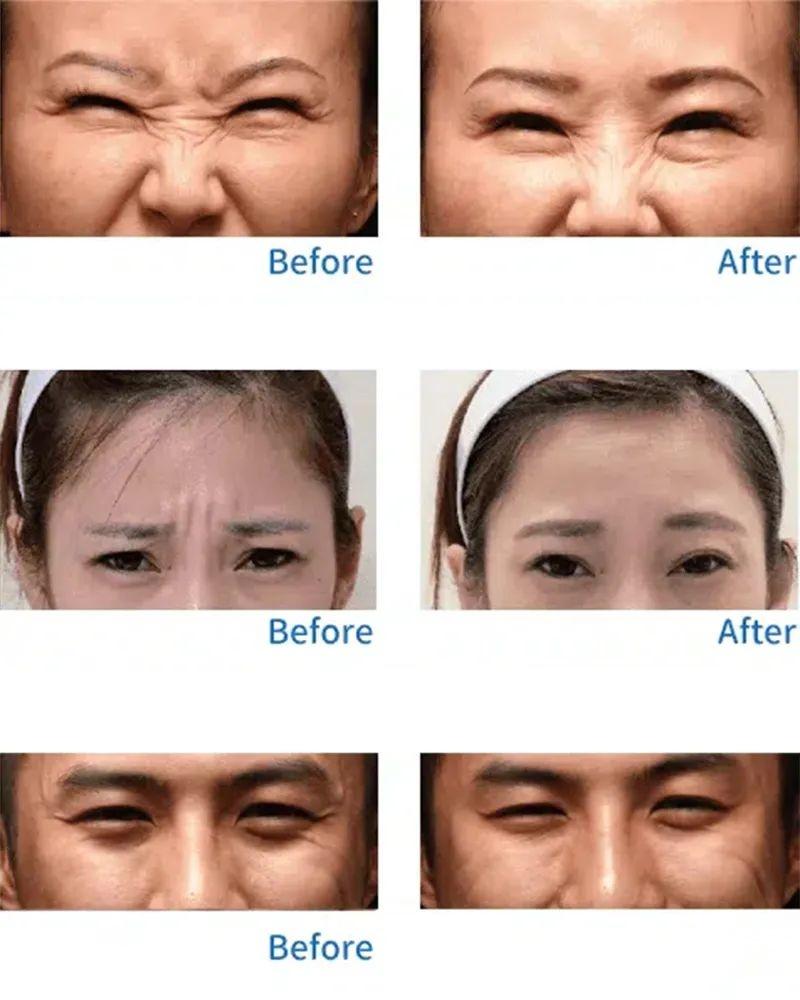 肉毒素品牌选择