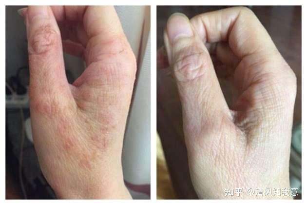 分享一下我的手上湿疹是怎么好的........（亲身经历分享） - 知乎