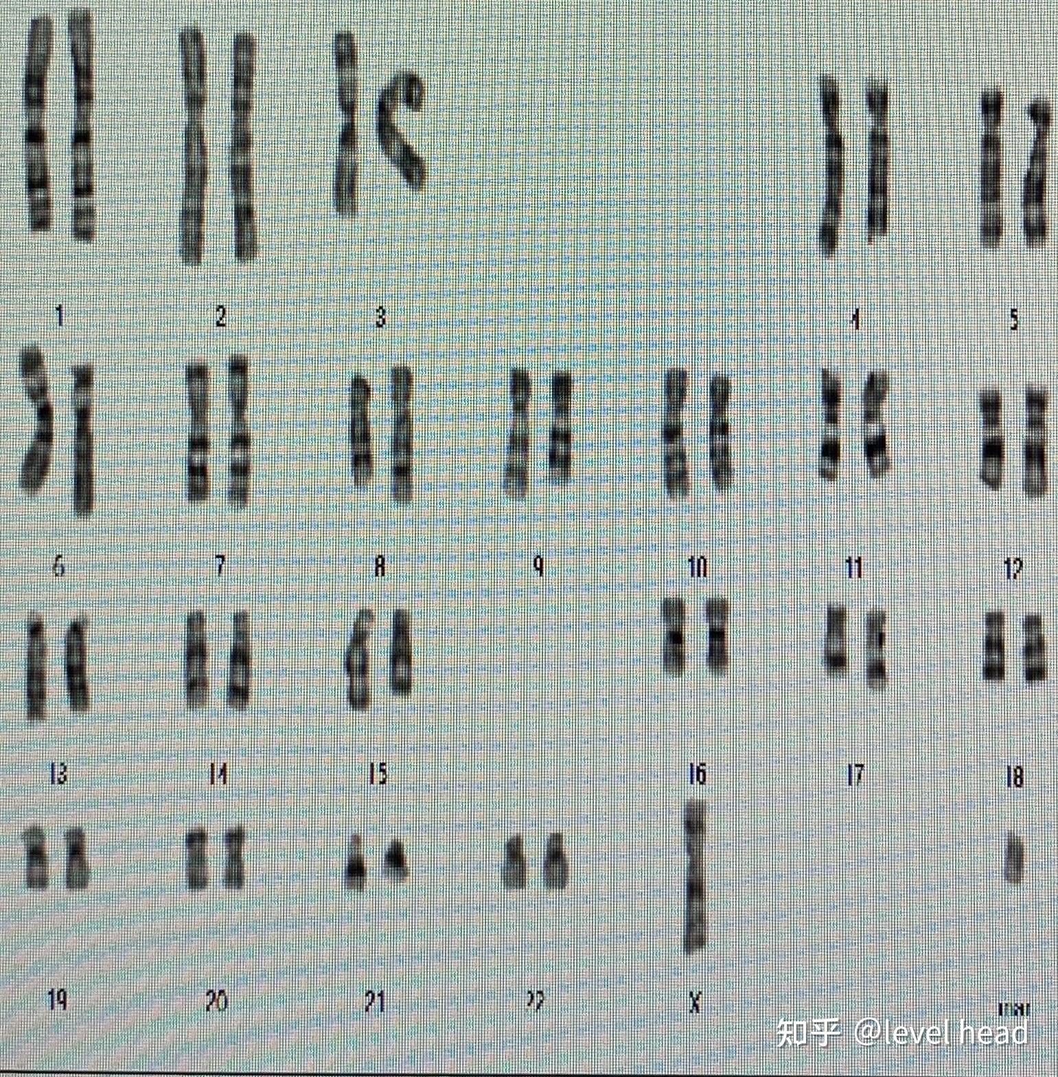 生殖遗传染色体异常的解读