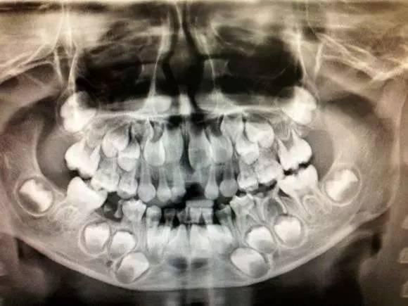 换牙期x光图片