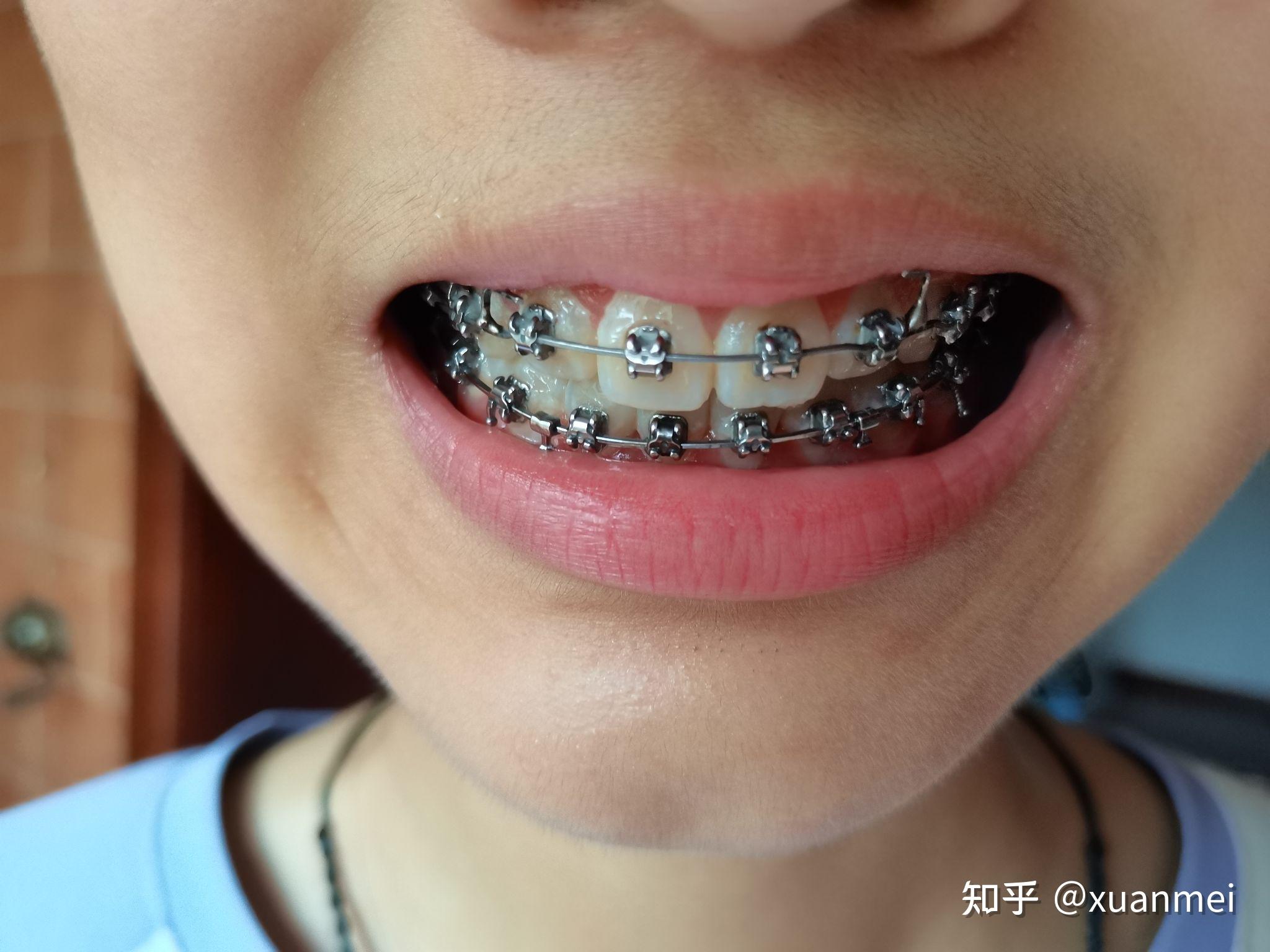 摘牙套前的记录，可是门牙咬合还有间隙 - 知乎