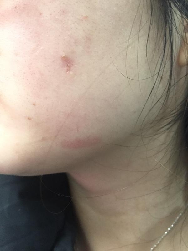 武汉第一医院手术去痣经历