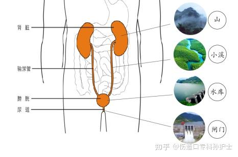 造口护理知识大全 - 知乎