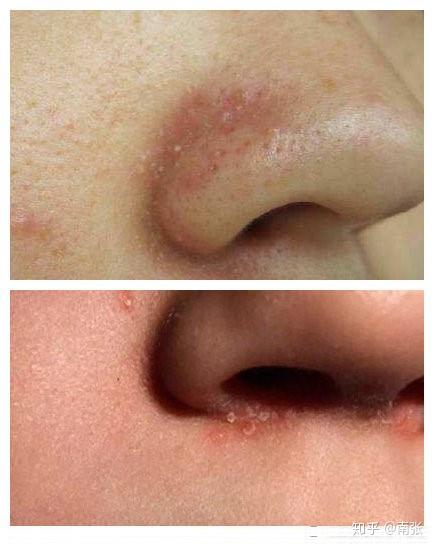 详细带解决方法面部脂溢性皮炎的解决方案皮肤科专家吉光宇