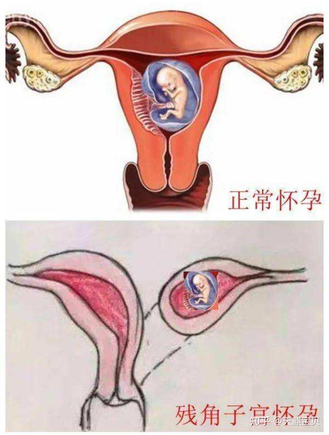 怀孕后子宫图片