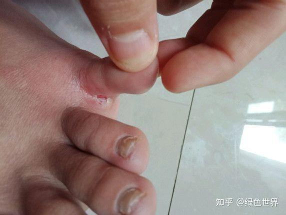 脚气到底怎么治方法总结