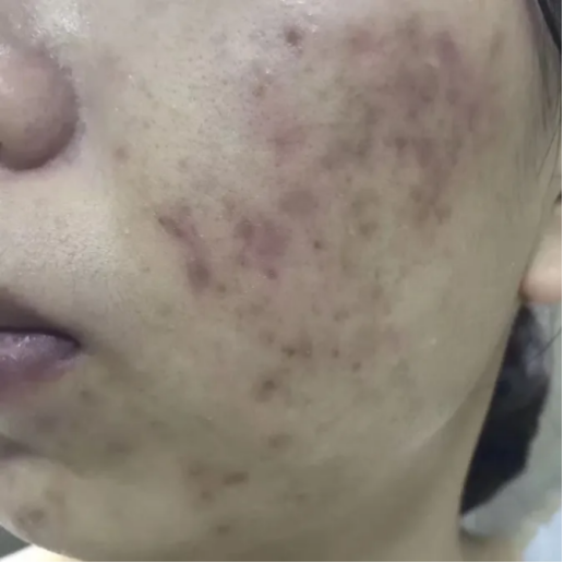 如何28天祛除脸上的痘印?【皮肤科医生】教你4步祛痘印最有效的方法 ! 不管红痘印&褐痘印&黑痘印,精准去除! - 知乎