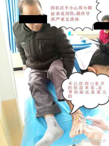 糖尿病脚底掉皮 糖尿病脚脱皮怎么治疗 糖尿病足脱皮照片