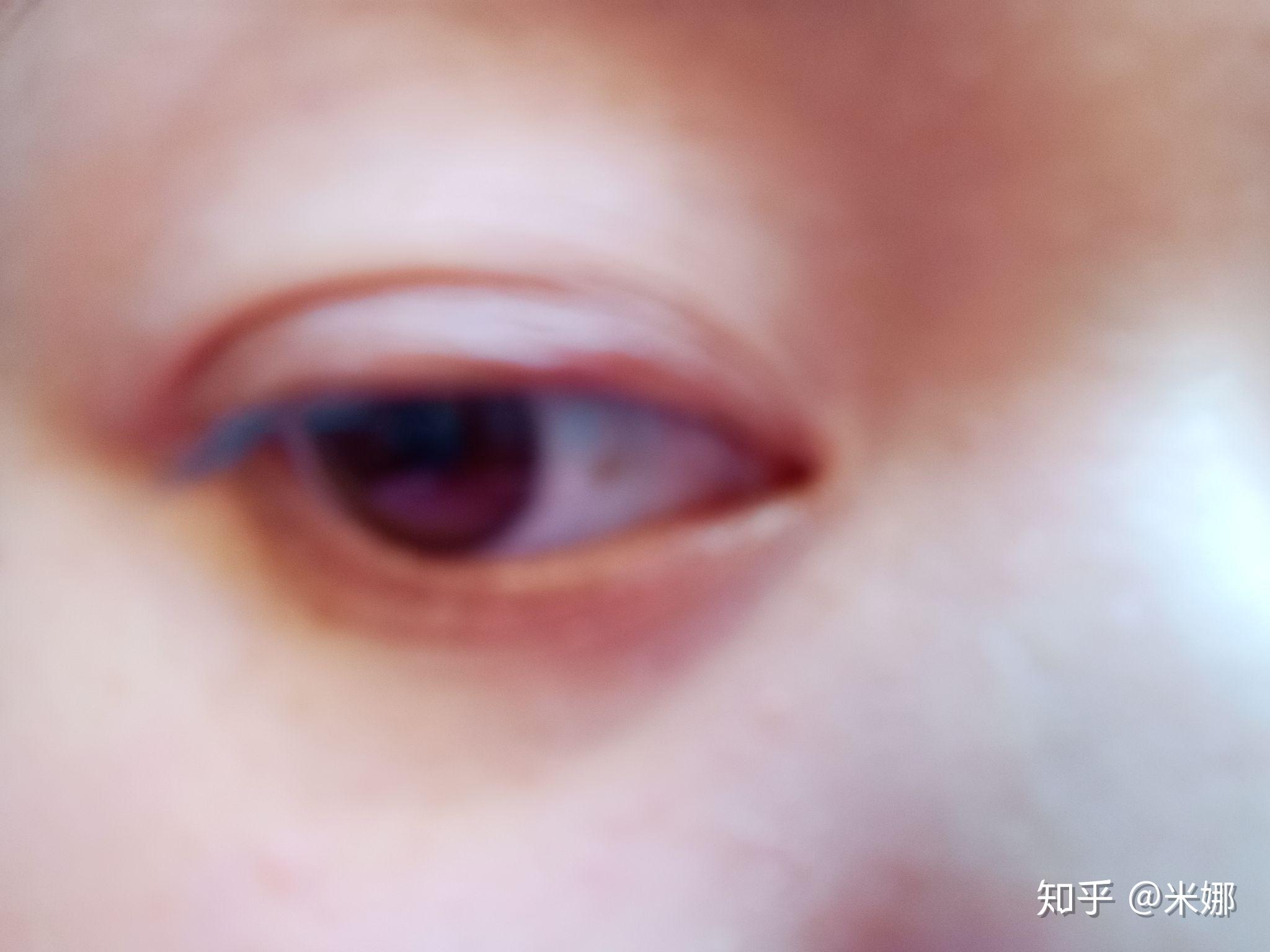目にも白斑があるのですが効果あり｜白斑を家庭用ナローバンドUVBで治療中 | 白斑日記