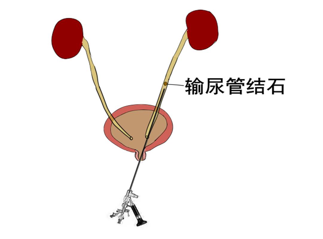 【一“马”当先】我院泌尿外科在湘西北地区率先开展“斑马”一次性输尿管软镜手术_患者