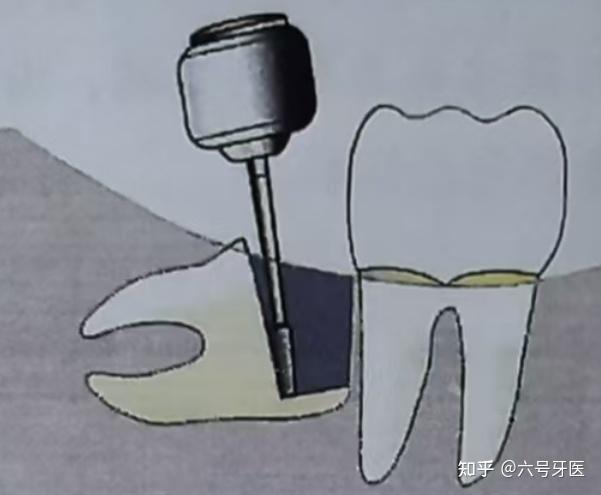 口腔拔牙技巧总篇 - 知乎