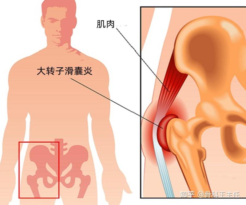 同样是滑囊炎