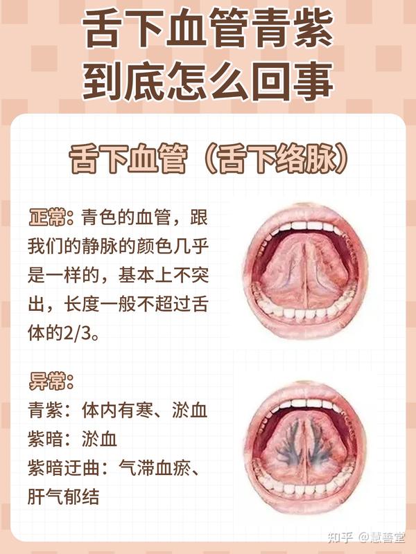 舌下血管青紫 ,到底怎么回事—慧善堂 - 知乎