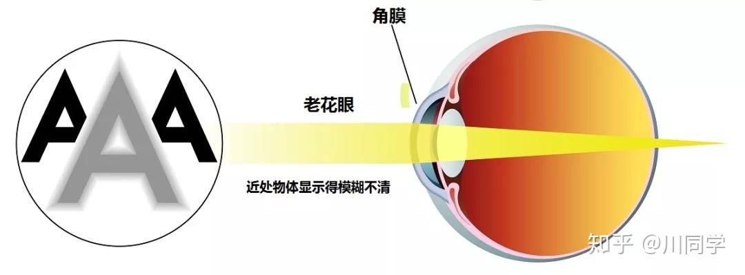 主要原因是眼部老化,引起的晶狀體硬化,睫狀肌收縮能力減弱,進而導致