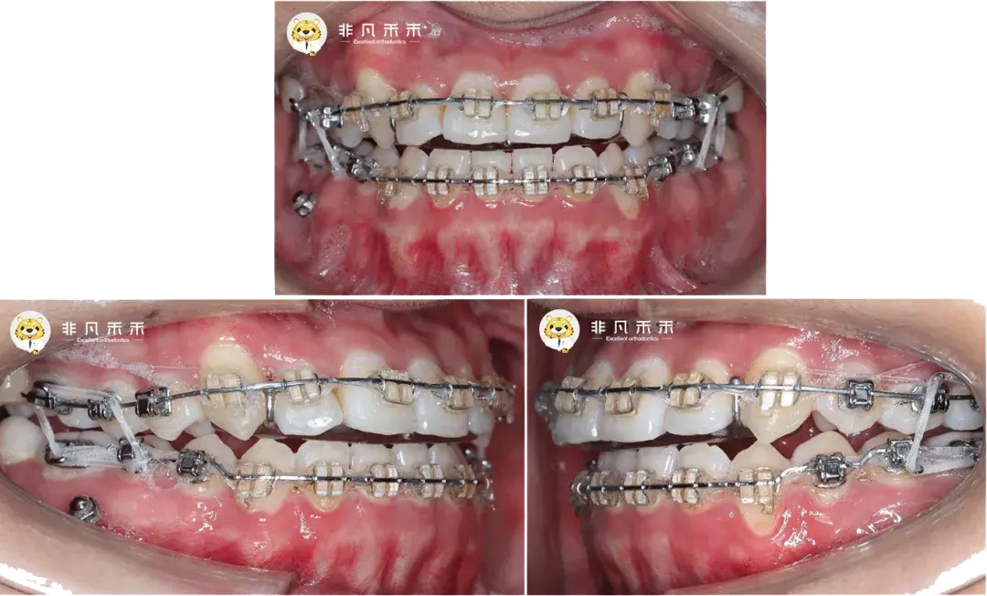 骨性嘴凸正畸效果图片