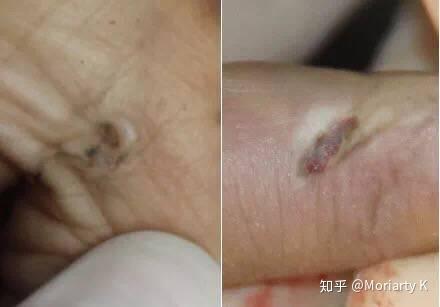 法医学讲堂(第壹期)——探秘【电击伤】