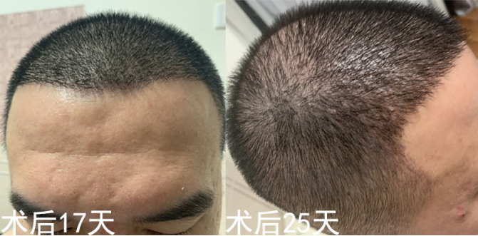 被狗咬伤后多久可以植发
