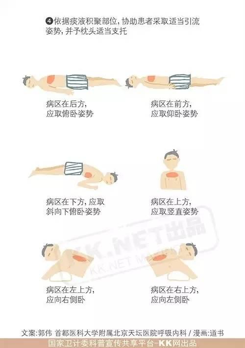 支扩患者的排痰-拍背排痰法 - 知乎