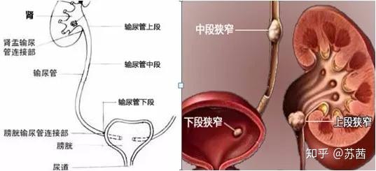 输尿管多粗图片