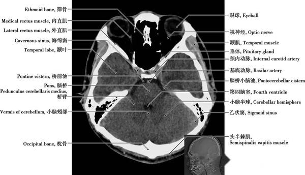 详细标注版!颅脑CT正常解剖图谱 - 知乎