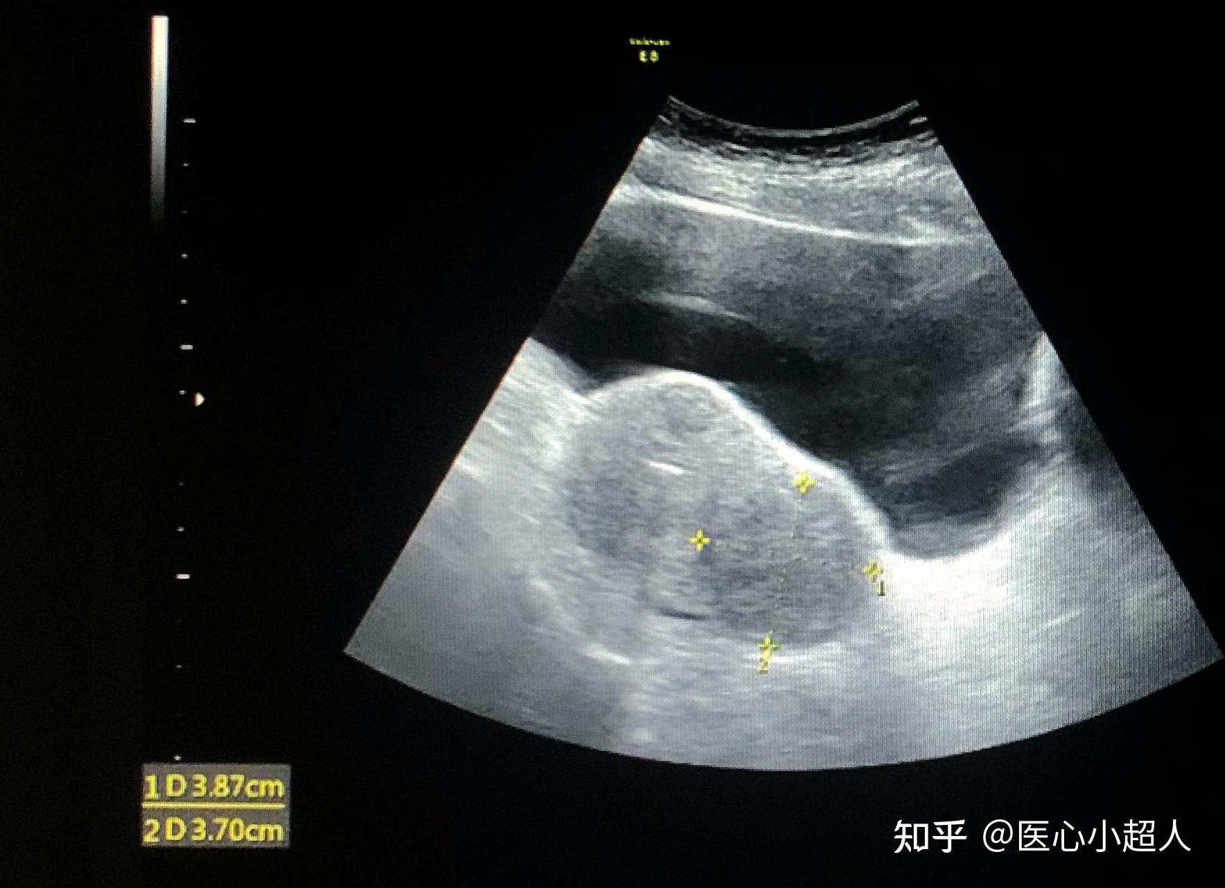 病例3 子宫黏膜下肌瘤(2)-妇产科学-医学