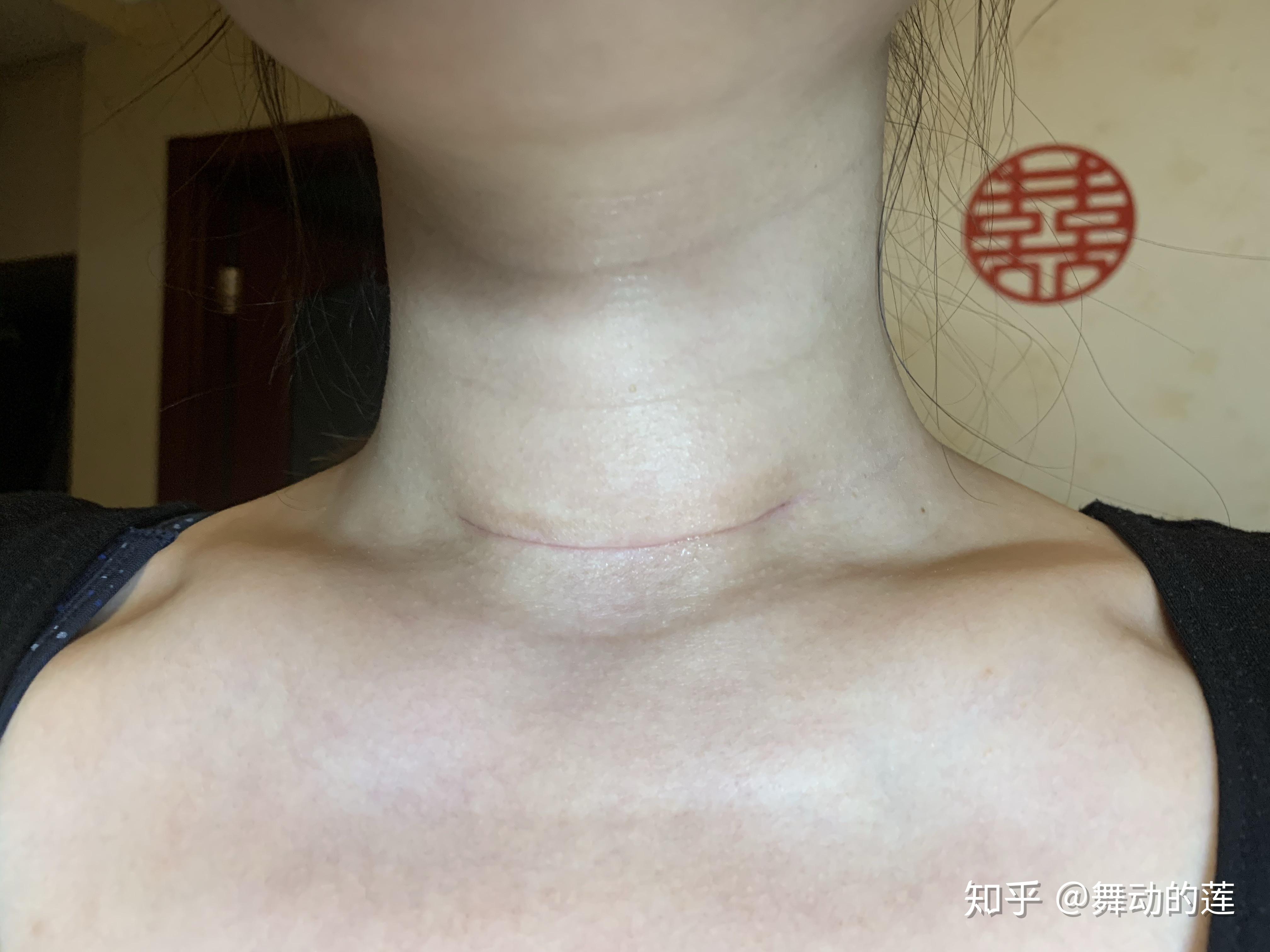 乳头手术恢复图片