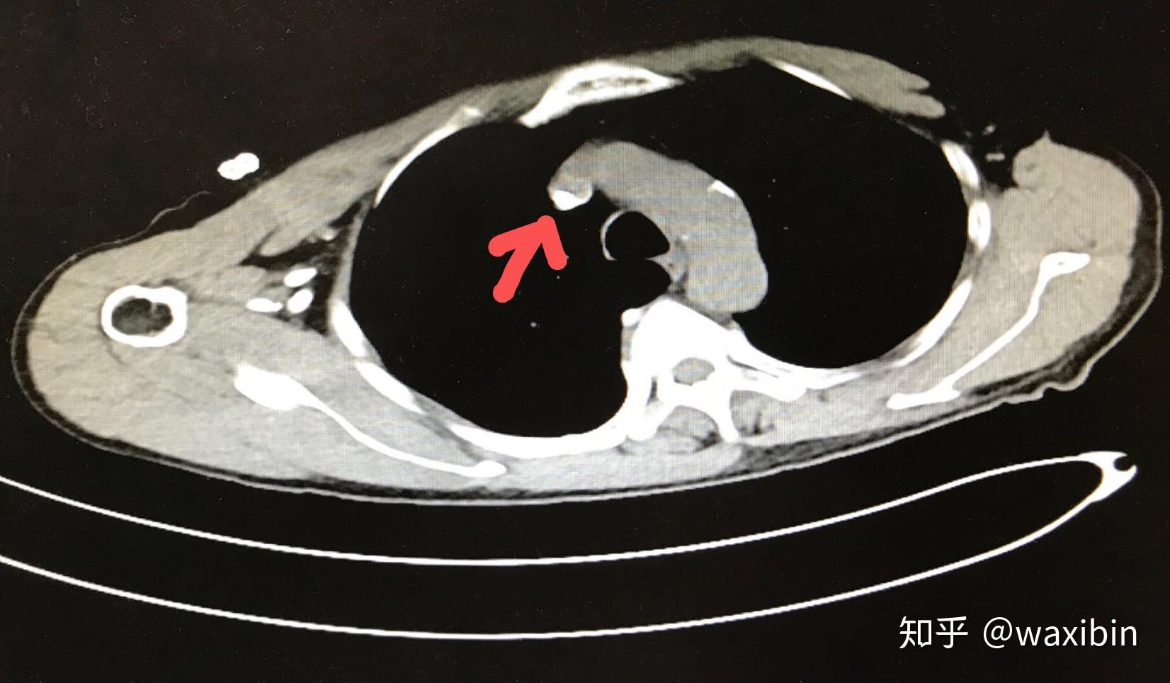 彩色多普勒超声:左前臂近肘部头静脉血栓形成;左上臂头静脉内径约2.