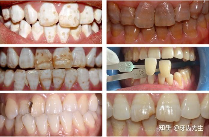 在银川氟斑牙四环素牙怎么办?原来还可以贴面